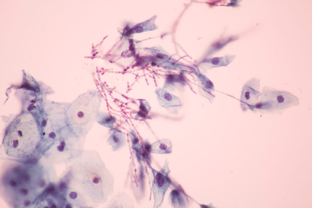 yeast infection treatment los angeles yeast infection treatment los angeles